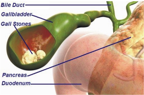 common bile duct stone. Primary ile duct stones