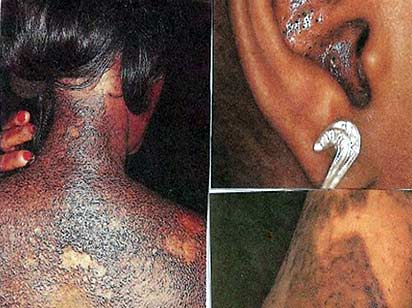 In extreme cases of skin bleaching, the skin can become multi-coloured and marred with inflammation or scarring.