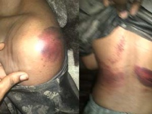 The victim with bruises