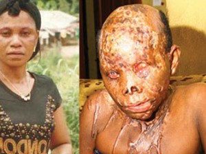 Paulina before and after the acide burnt