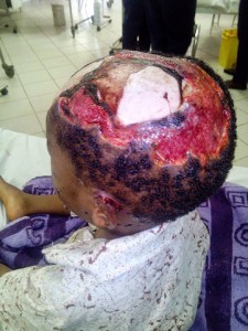 Dog-bite-victim,-Omoniho-Abraha