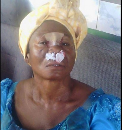 One of the protesters allegedly injured by security operatives during Tuesday's protest in Awka, the Anambra state capital, by members of IPOB