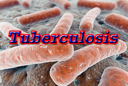 Tuberculosis