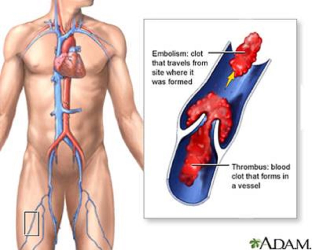 Lockdown: Exercise regularly to prevent thrombosis, Pharmacist advises Nigerians