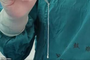 Doctors remove live six-inch parasite from Chinese woman's brain