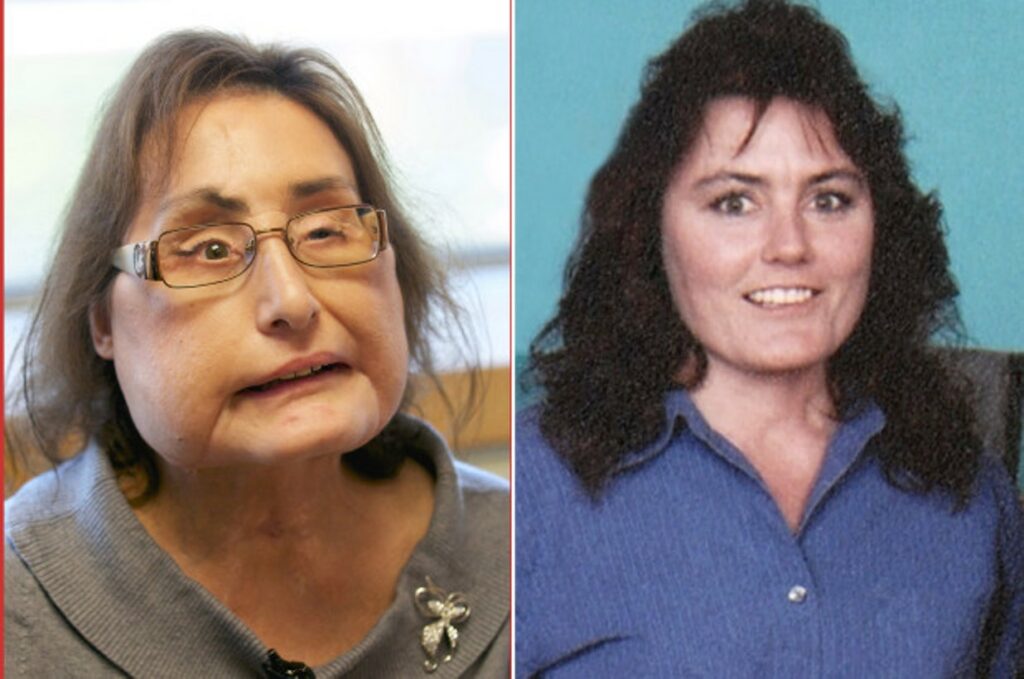 First US recipient of partial face transplant dead at 57